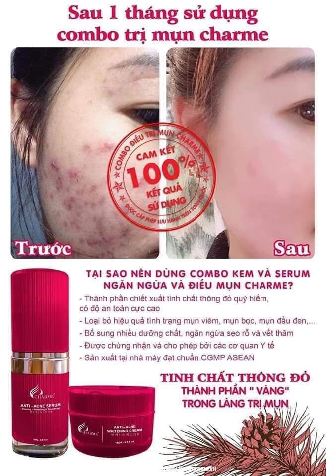 Combo Kem và Serum Trị Mụn Trắng Da Thông Đỏ Charme Anti Acne